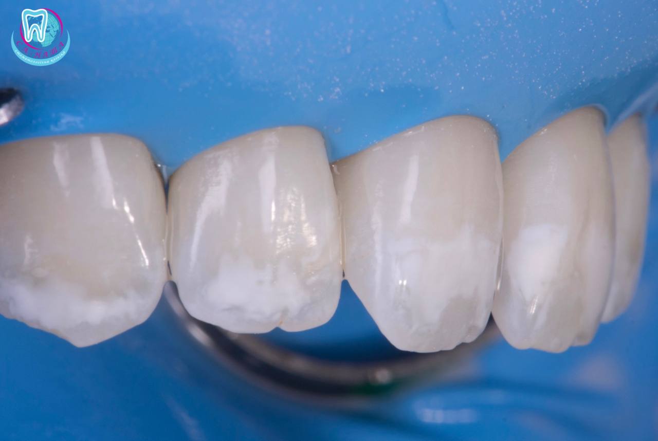 Признаки трещины в эмали зуба